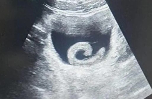 Nguoi dan ong phai nhap vien cap cuu vi dia song trong bang quang hinh anh