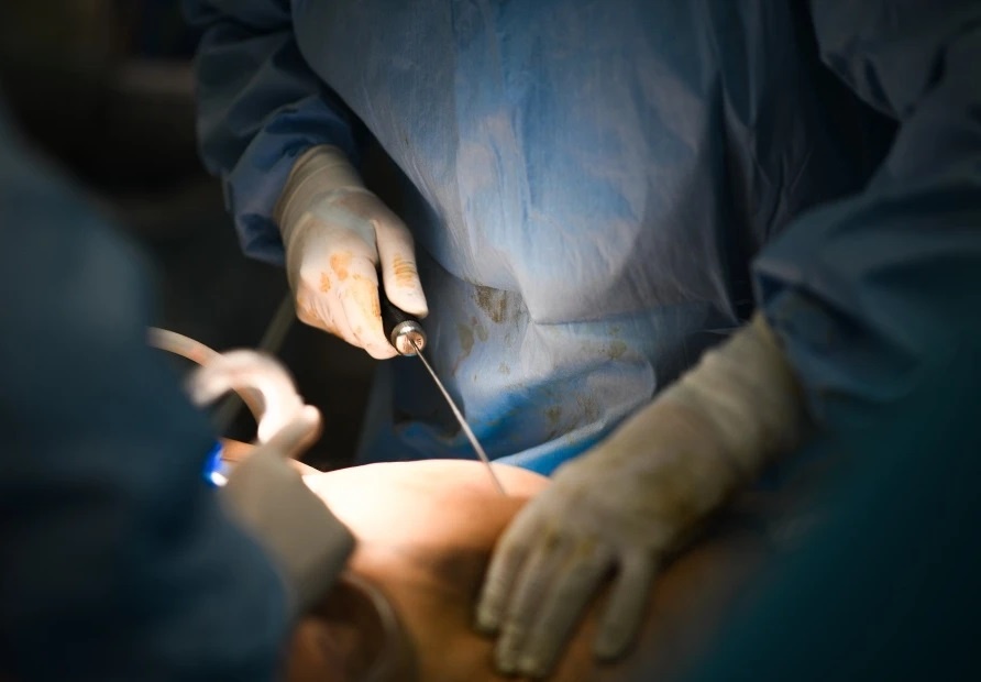 Nguy kich sau hon 7 tieng hut mo bung, cay mo mat, ghep mo mong o spa hinh anh