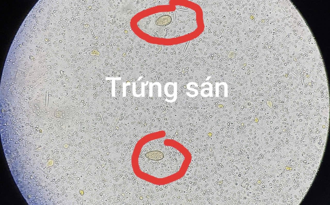 Thoi quen xau kho bo khien nguoi dan ong hu gan, san chi chit hinh anh