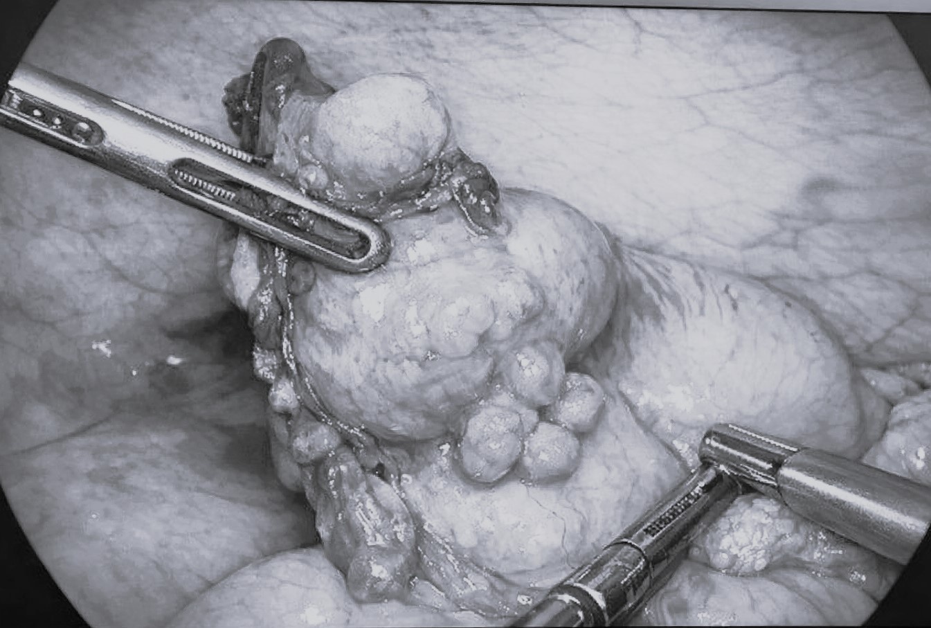 Di kham vi mot trieu chung, dau xot phat hien ung thu ruot thua hinh anh