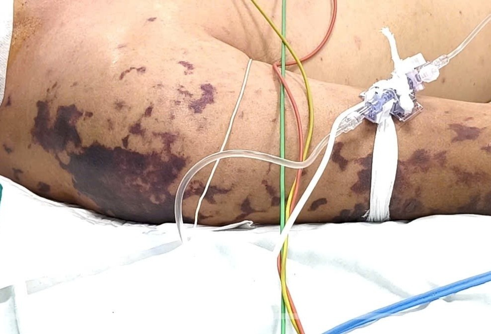 Tham tim khap nguoi sau bua tiec vi nhiem khuan nao mo cau hinh anh