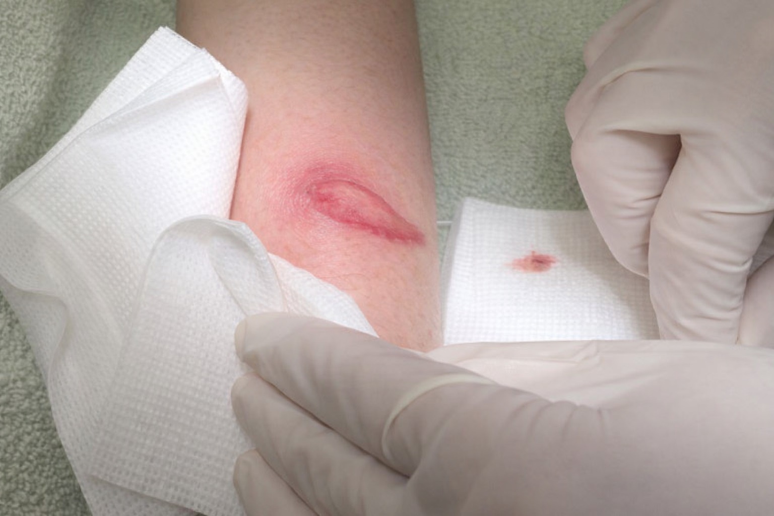 Ganh hau qua dau long vi non nong tiem filler vong ba hinh anh