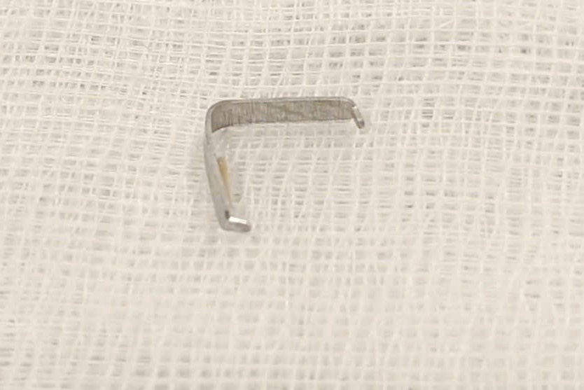 Be trai quay khoc, bac si ta hoa phat hien vat sac nhon gam trong hong hinh anh