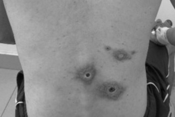 Dau hieu giang mai giai doan dau hinh anh