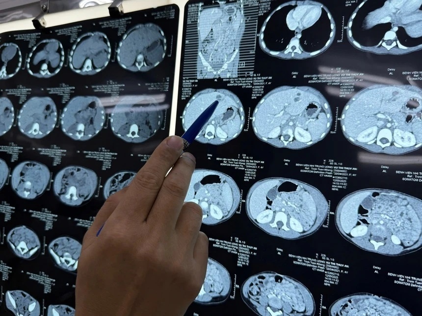 Dieu gi xay ra khi nhiem giun san, lau ngay khong xo? hinh anh