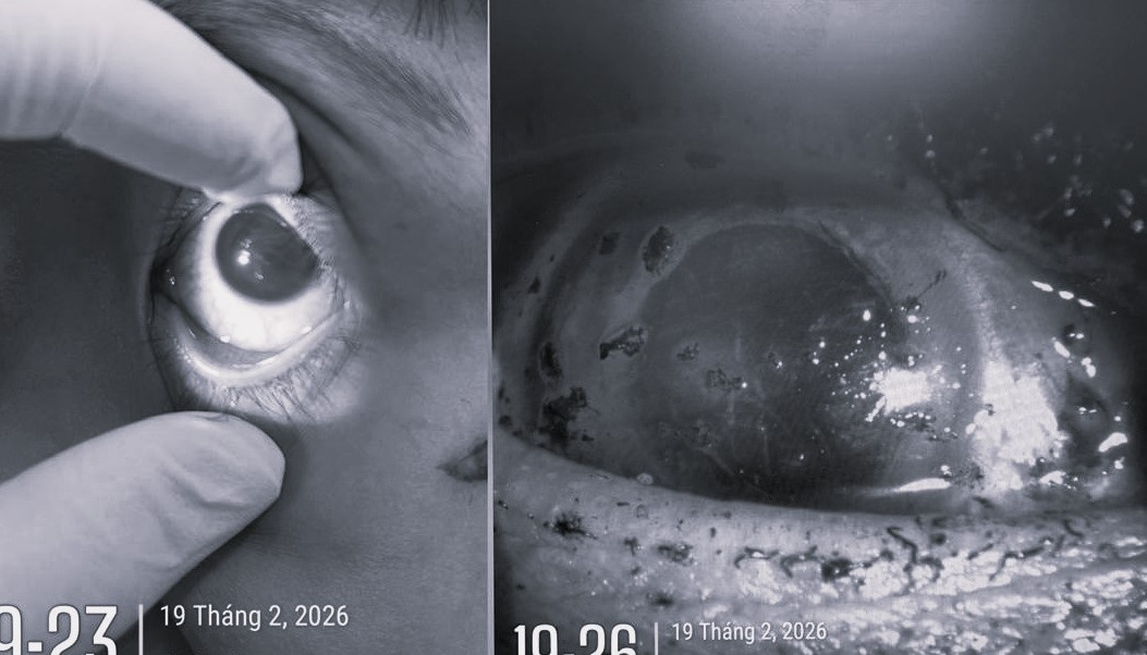 Sau tieng no lon ngoai san, nguoi phu nu mat vinh vien nhan cau hinh anh