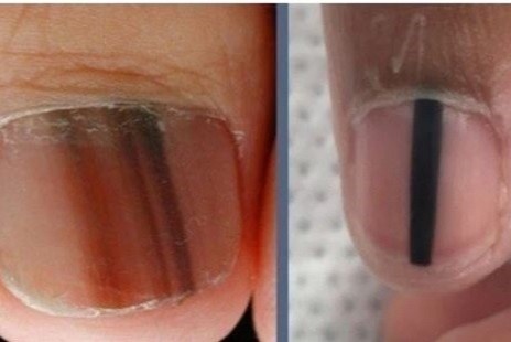 Soc sam mau tren mong tay, mong chan la bieu hien cua benh gi? hinh anh