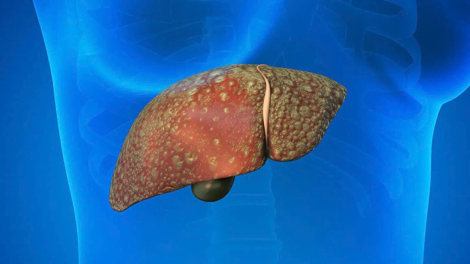 Benh gan tang vot sau Tet: Bac si neu thoi quen dang 'buc tu' noi tang hinh anh