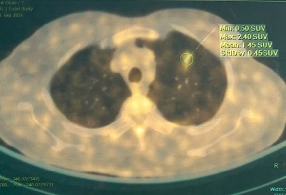 Thoi quen kho bo suot nhieu nam khien nguoi dan ong mac ung thu hinh anh