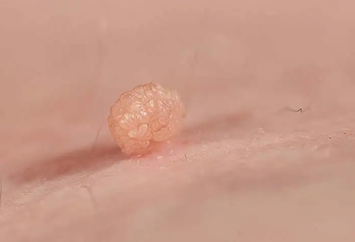 Sui mao ga co the chua khoi khong? hinh anh