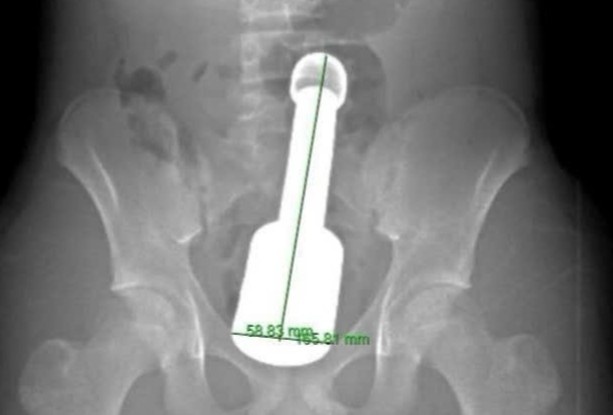 Thieu nien 15 tuoi vao vien khan cap vi chiec chay 18 cm trong hau mon hinh anh