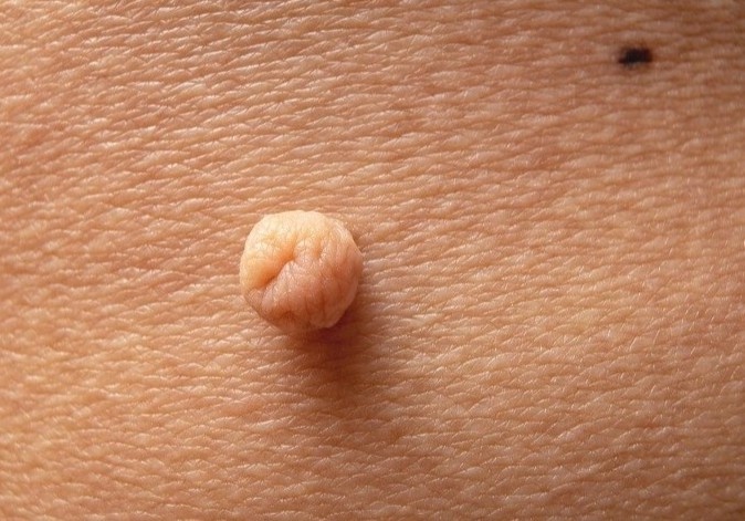 Gan 70 tuoi van mac sui mao ga hinh anh