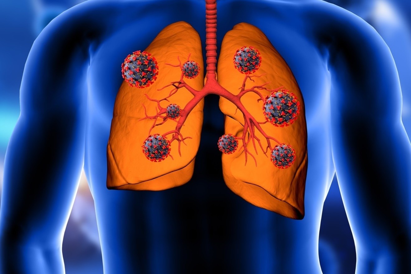 Loai ung thu ngay cang pho bien o Viet Nam: Ai nen tam soat som? hinh anh