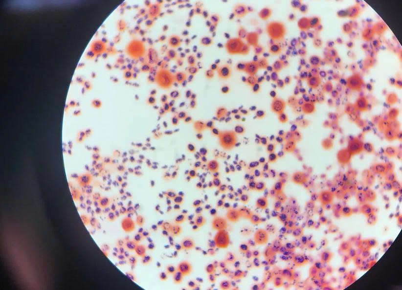 Bat ngo phat hien nam nguy hiem trong nao tu trieu chung thuong gap hinh anh