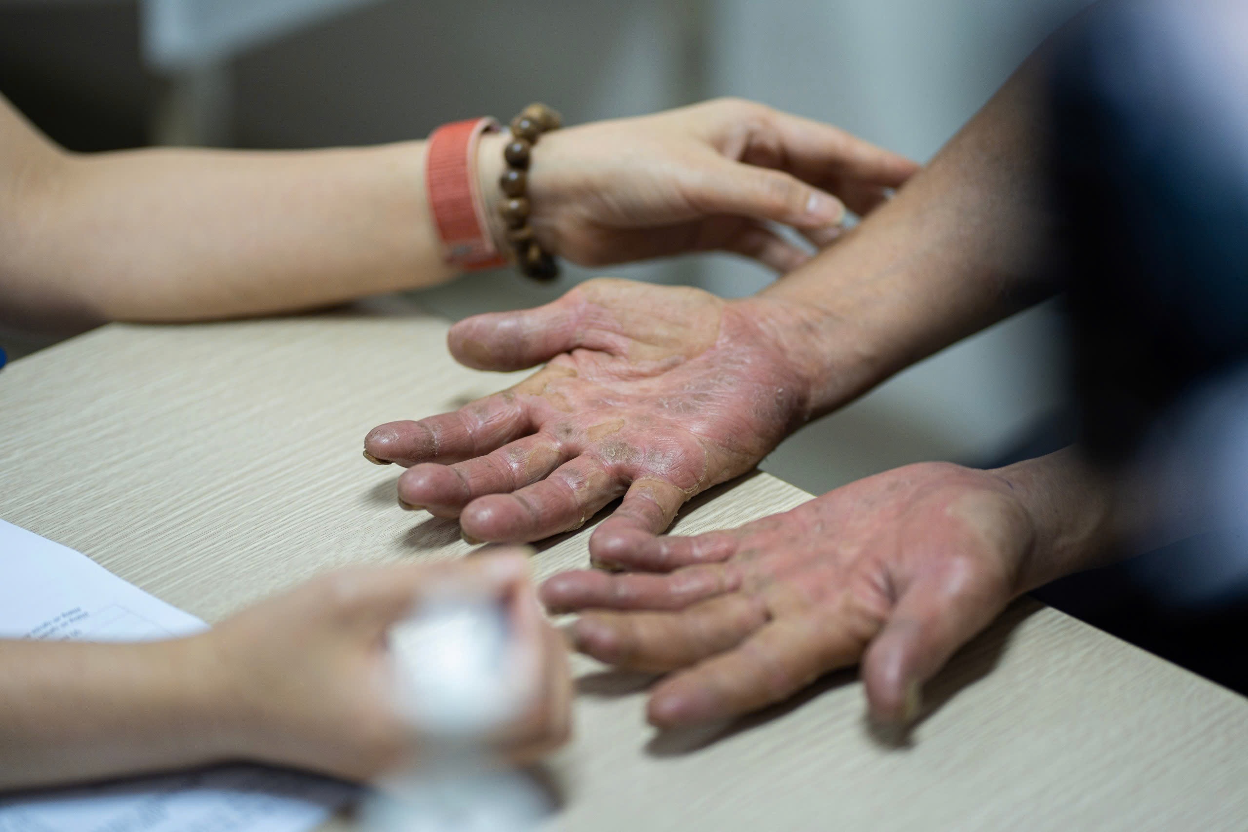 Benh da lieu tang vot, bac si canh bao dieu dang lo hinh anh