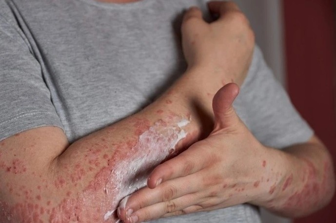 Can benh mot nguoi mac, ca gia dinh phai chua cung luc hinh anh