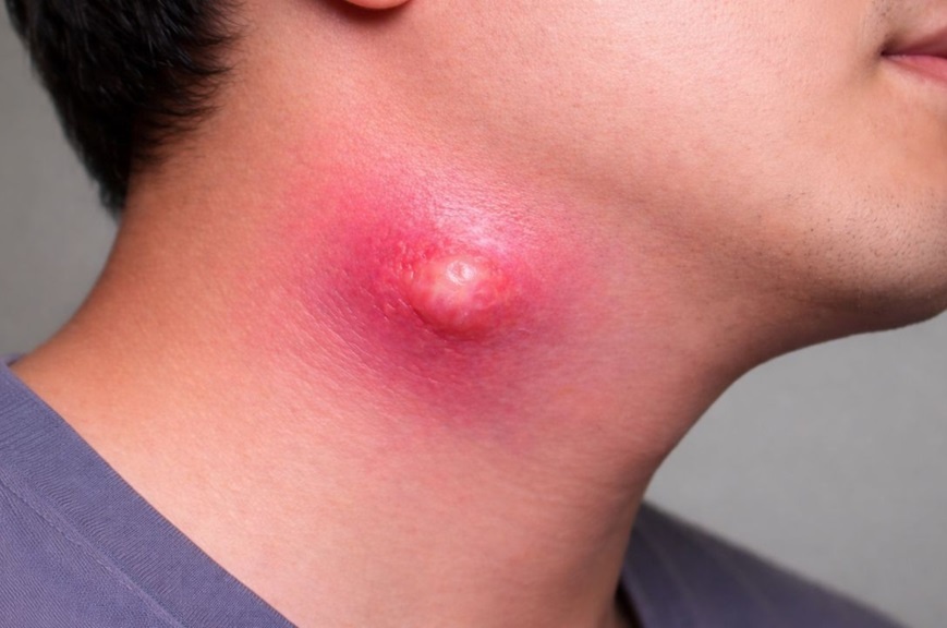 5 dau hieu o co chi diem o mu dang am tham an sau hinh anh