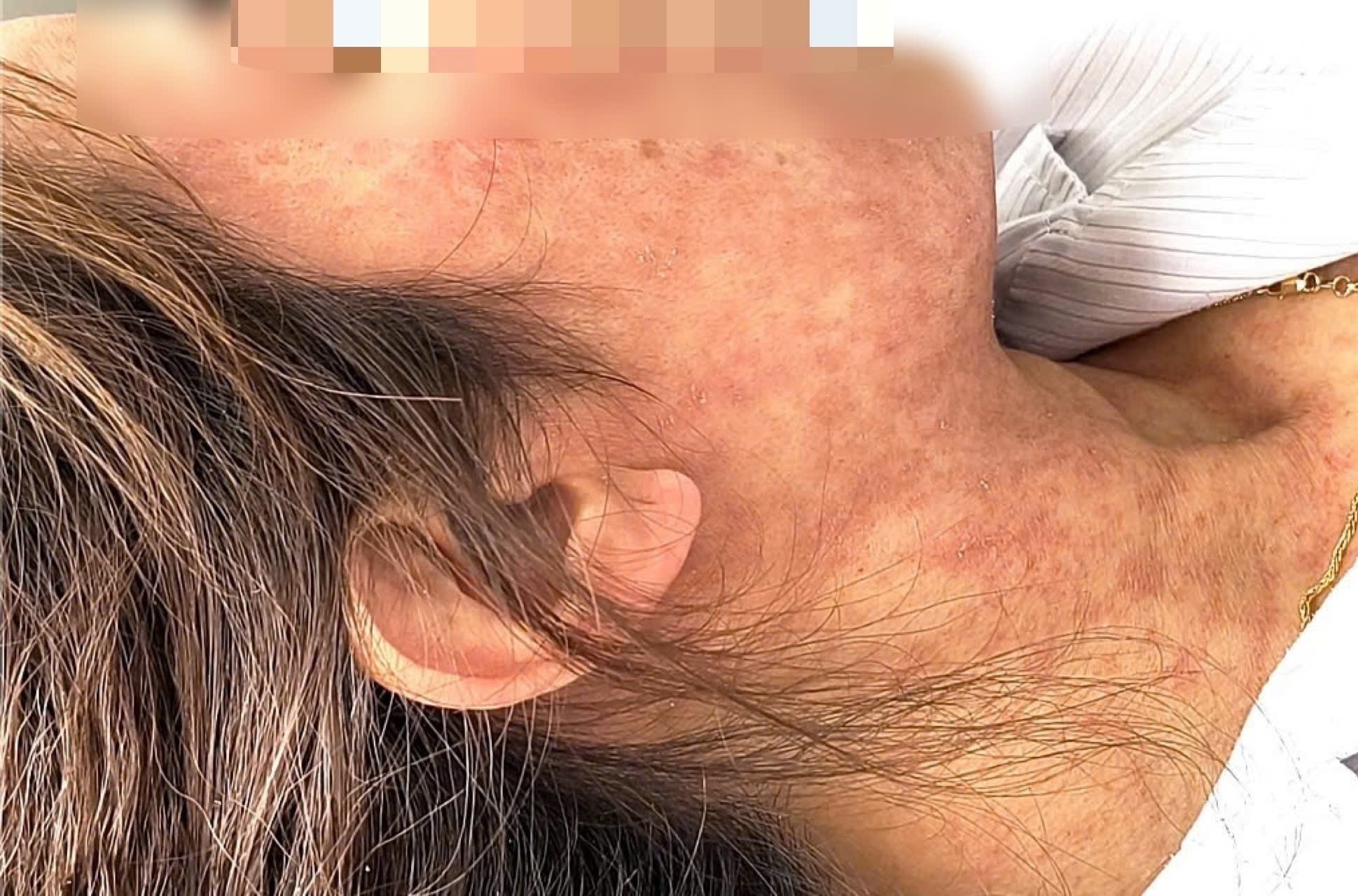 Lay benh tu chau, nguoi phu nu nhap vien voi hang loat bien chung hinh anh