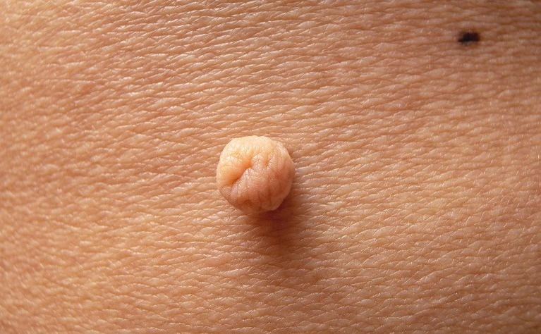 Sui mao ga ngay cang phuc tap hinh anh