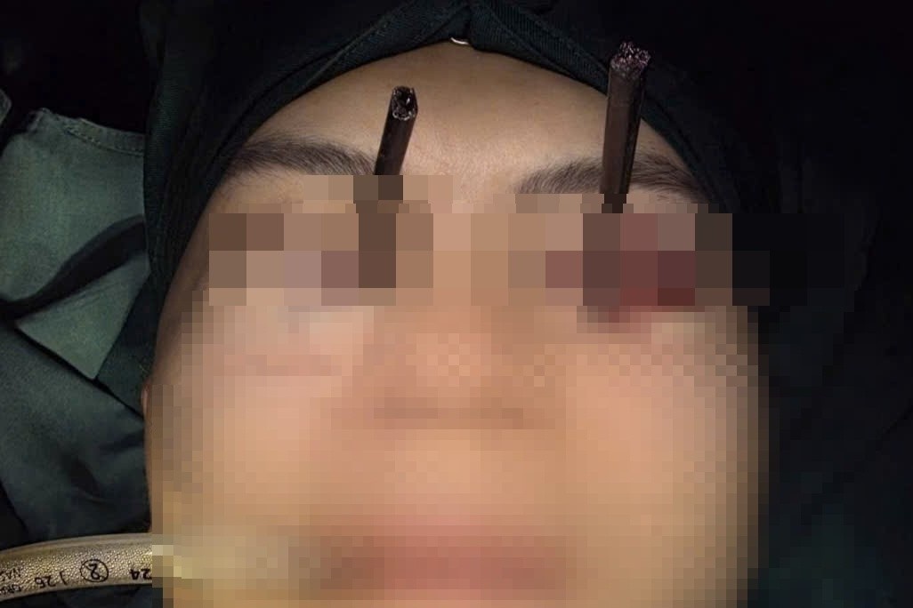 Thanh nien den vien cap cuu voi 2 chiec dua dam sau vao 2 mat hinh anh