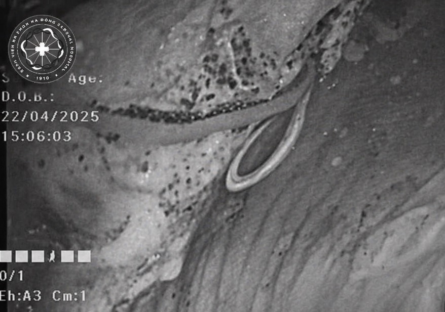 Bac si kinh ngac khi noi soi dai trang cho benh nhan hinh anh