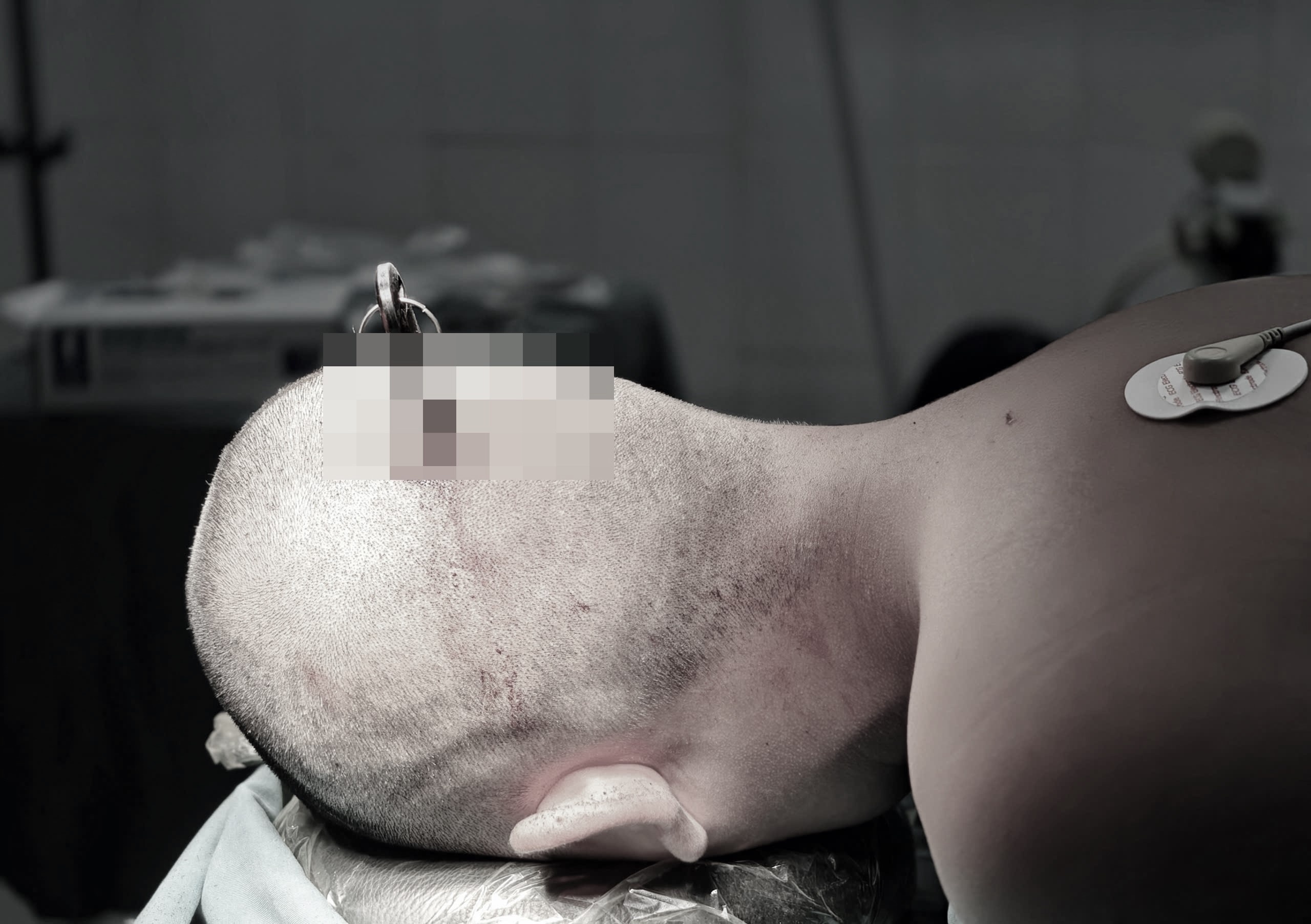 Nam sinh nhap vien voi chiec chia khoa dam xuyen so hinh anh