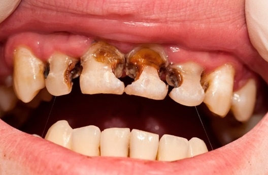 Rang xau anh 1