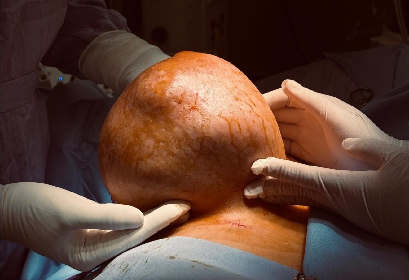 Chiu dung vong mot nang 3,5 kg, nguoi phu nu phai phau thuat gap hinh anh