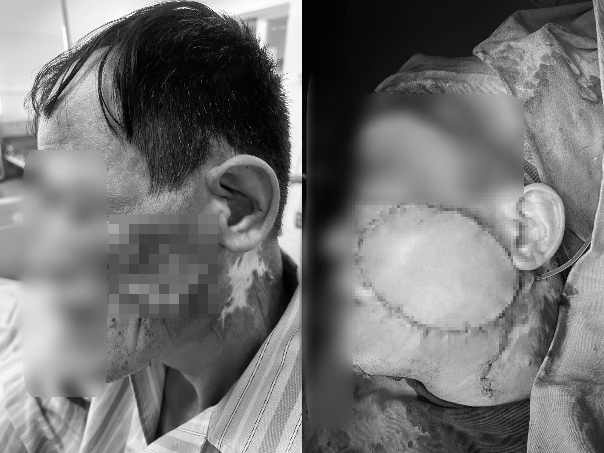 Tu not nho vung ma, nguoi dan ong phat hien ung thu gay bien dang khuon mat hinh anh