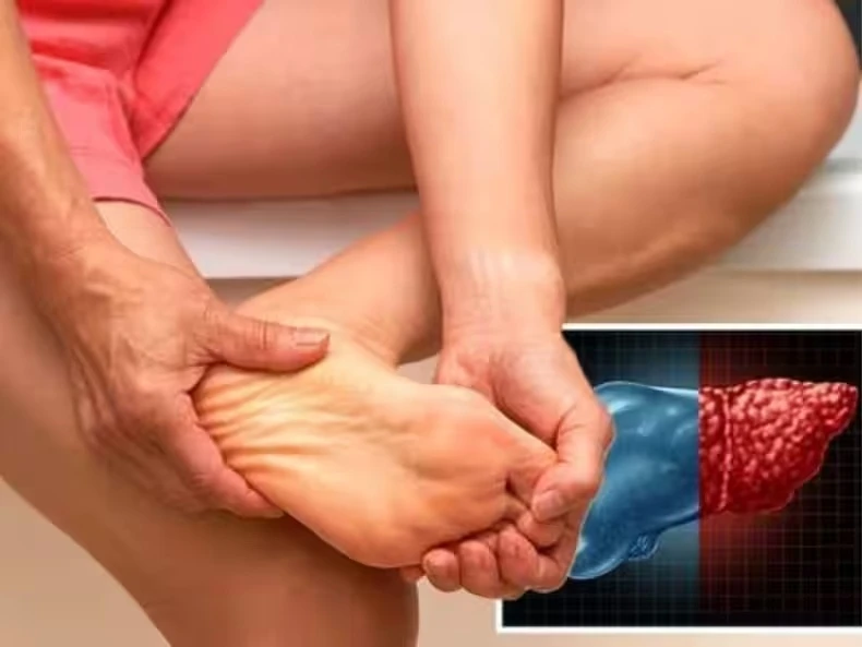5 tín hiệu cảnh báo bệnh gan giai đoạn đầu