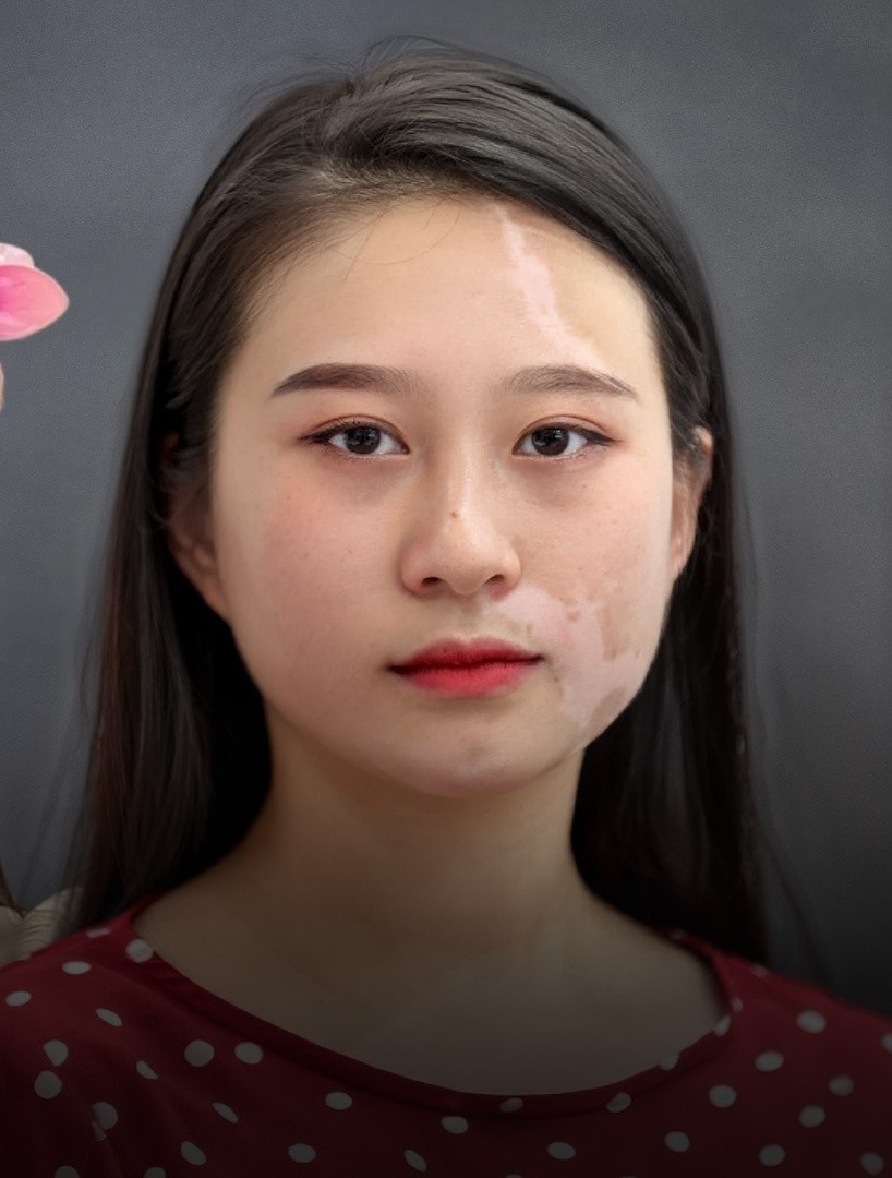 Ước mơ của cô gái xinh đẹp 20 năm bị căn bệnh tàn phá diện mạo