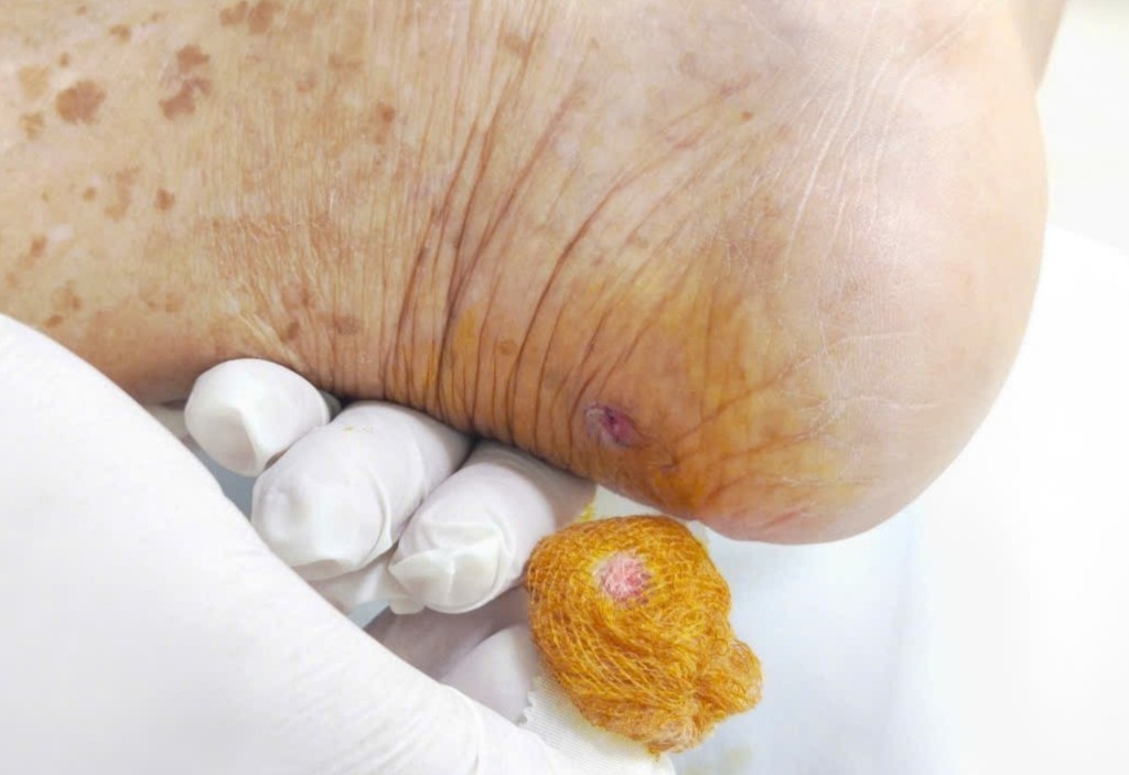 Ngỡ vết thương nhỏ không đáng kể, hai bệnh nhân bất ngờ nguy kịch