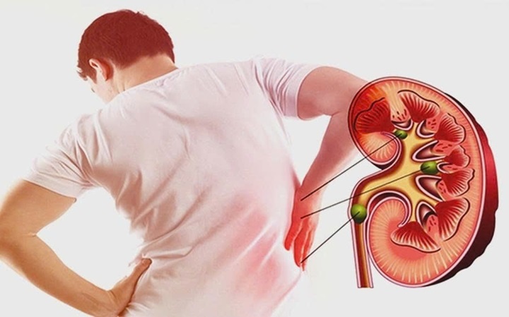 3 nhóm người có nguy cơ suy thận cao nhưng thường chủ quan