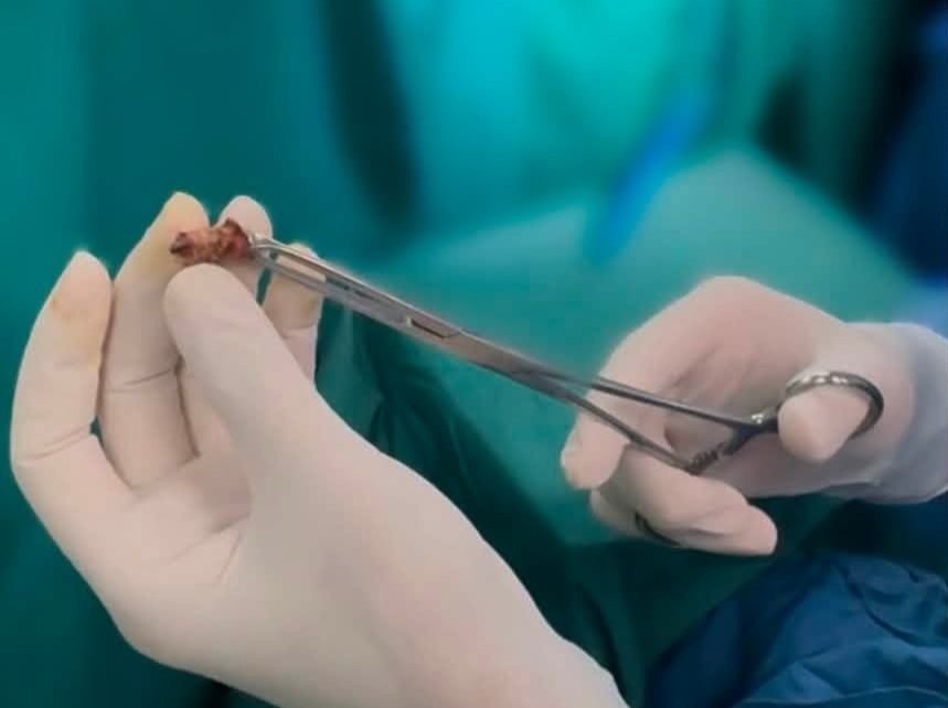 Sai lầm khi chữa trĩ, người đàn ông gánh hậu quả đau đớn