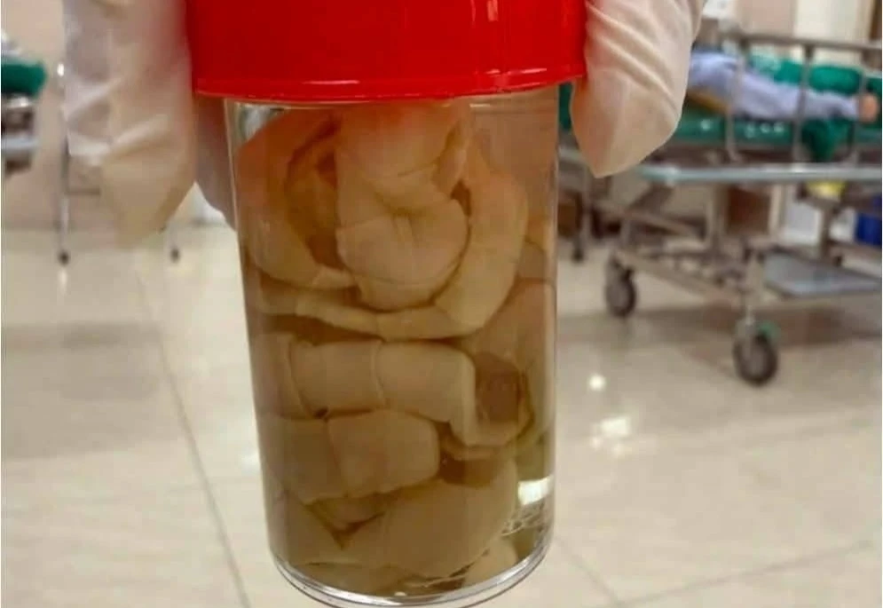 Bác sĩ kinh ngạc gắp con sán dây bò dài 1,2 m trong ruột bệnh nhân
