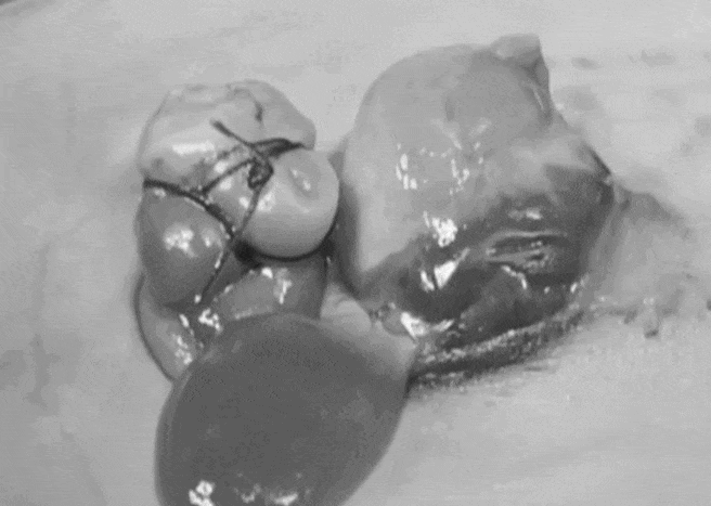 Em bé chào đời với một phần trái tim nằm ngoài cơ thể