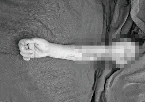Nối liền cánh tay cho bé 4 tuổi gặp tai nạn với áo chống nắng