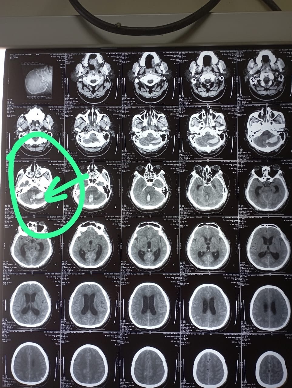 Đột quỵ ảnh 2