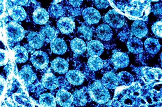 SARS-CoV-2 có thể kích hoạt virus tiềm ẩn, hé lộ cơ chế 'long Covid'