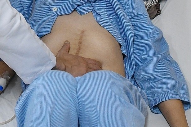Từ một dấu hiệu, phát hiện mắc khối u ác tính và 39 polyp ở đại tràng
