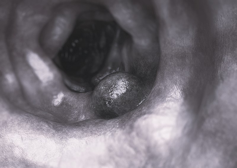Phát hiện khối u ác tính và 39 polyp đại tràng từ một biểu hiện lạ