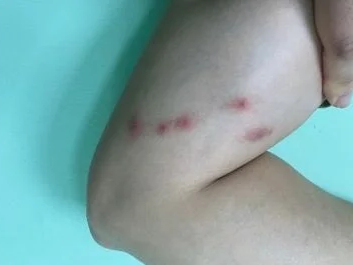 Ba nốt đỏ xếp thành hàng, dấu hiệu không nên bỏ qua