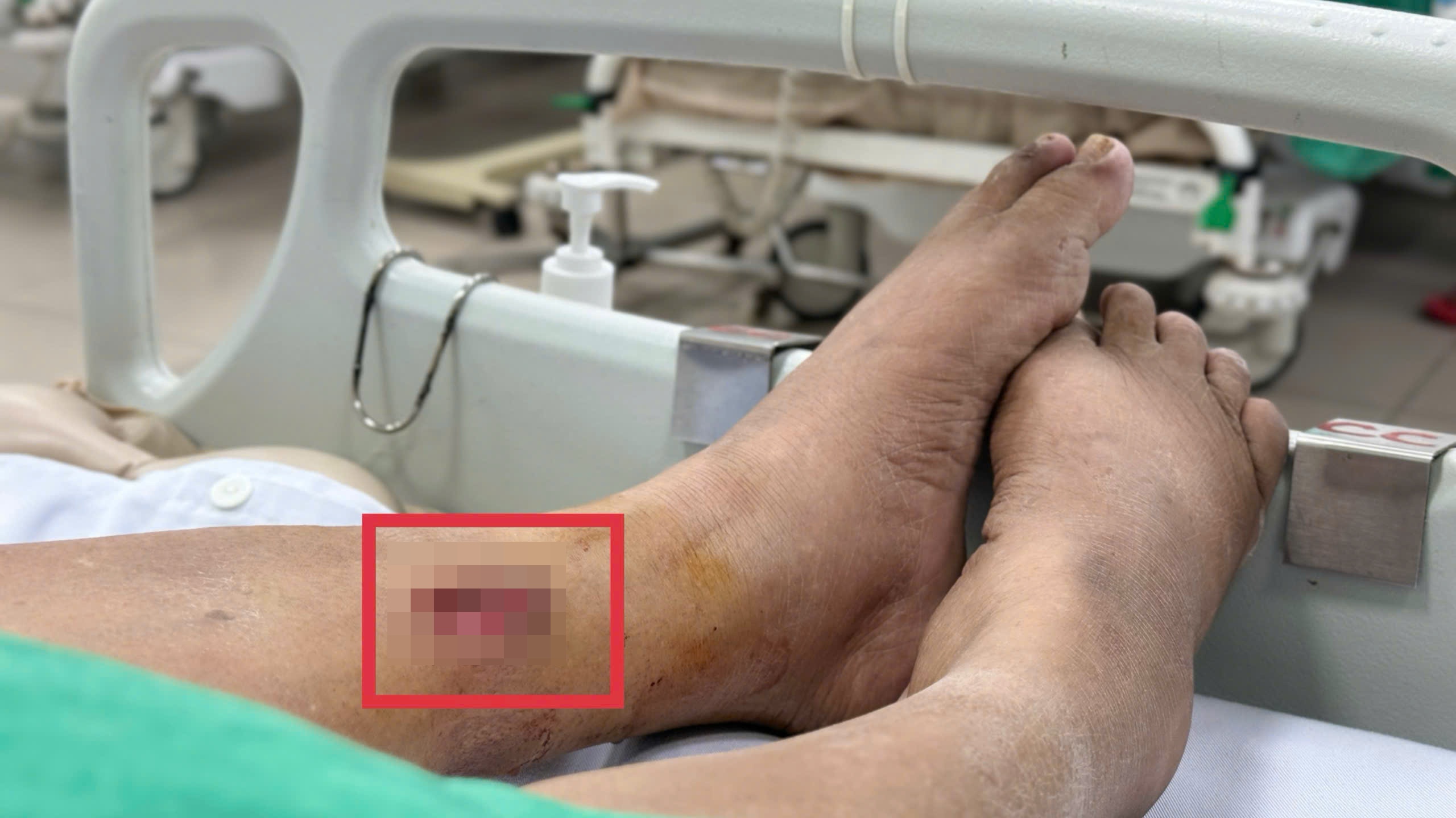 Vết thương đã lành, thứ còn sót lại khiến người phụ nữ nguy kịch