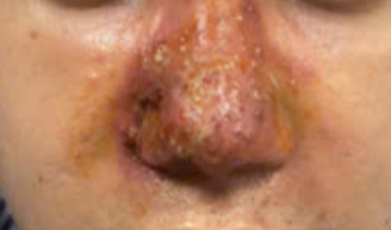 ti&ecirc;m filler ảnh 1
