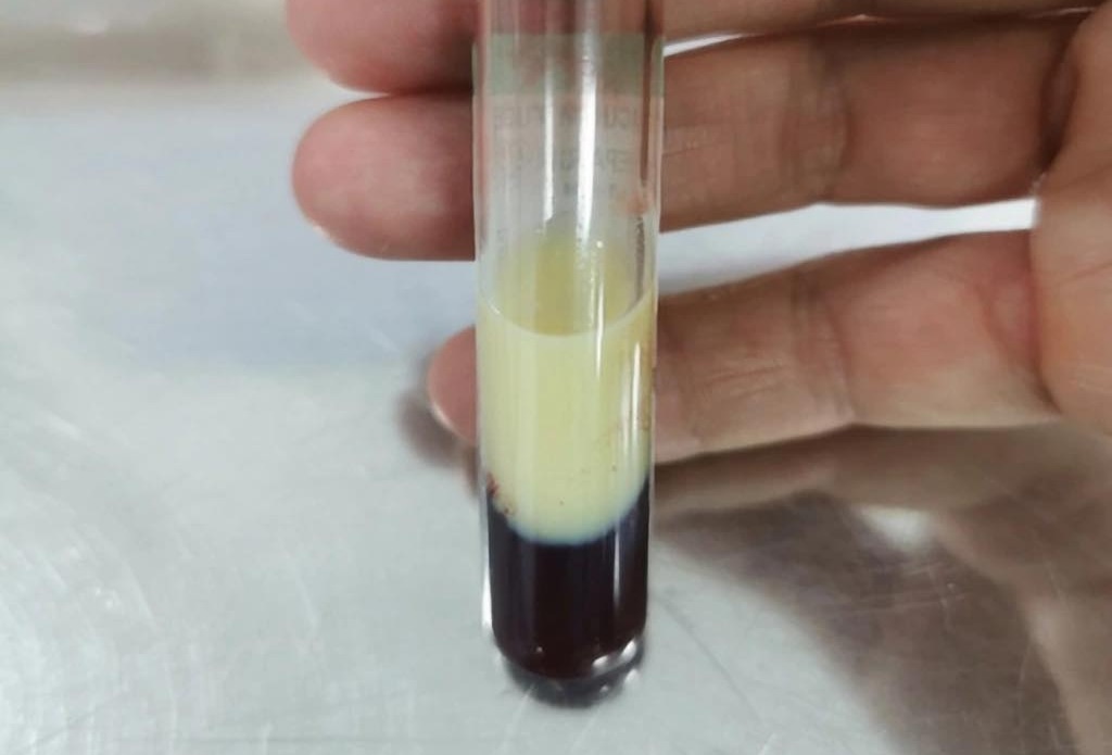 Một thói quen sau ăn khiến mỡ máu tăng vọt