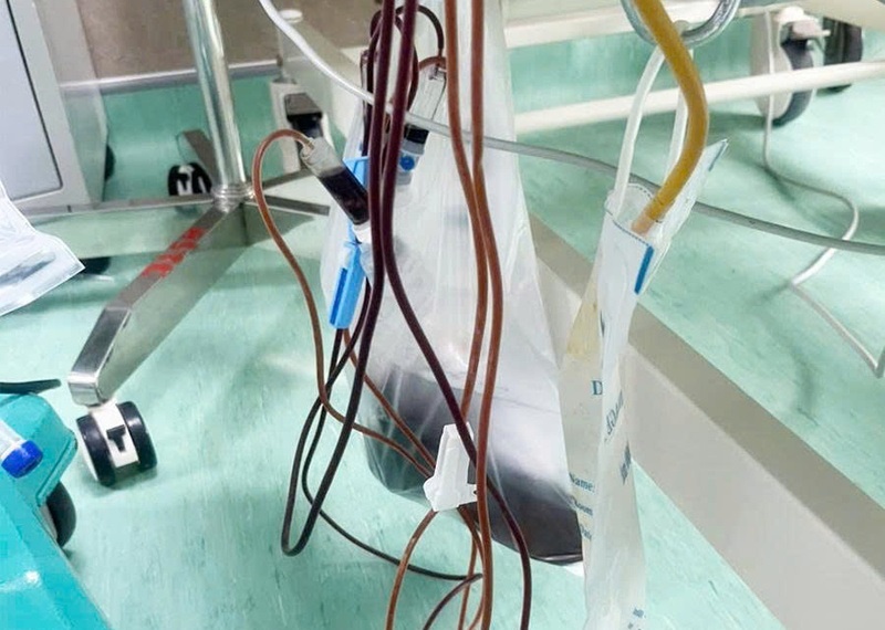 Người đàn ông đi cấp cứu với mỡ máu tăng 20 lần, máu đục như sữa
