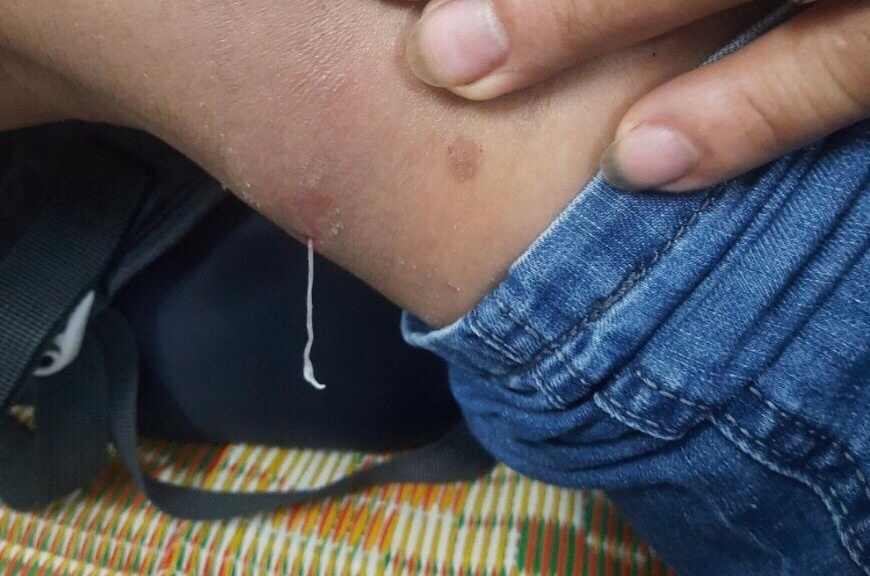 Giun rồng đục khoét, chui ra từ dưới da bệnh nhân