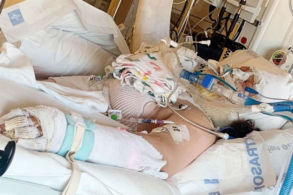 Be gai bi bong nang do lam theo video tren TikTok hinh anh