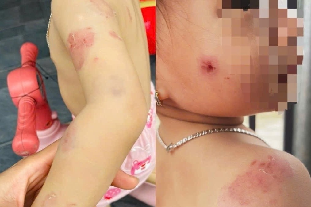 Be gai hon 2 tuoi chi chit vet can tren nguoi sau gio hoc hinh anh