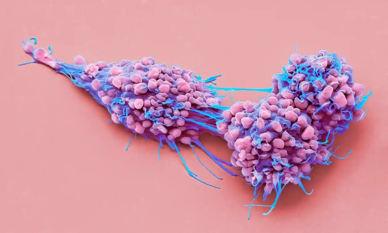 Dot pha bat ngo trong dieu tri ung thu buong trung hinh anh